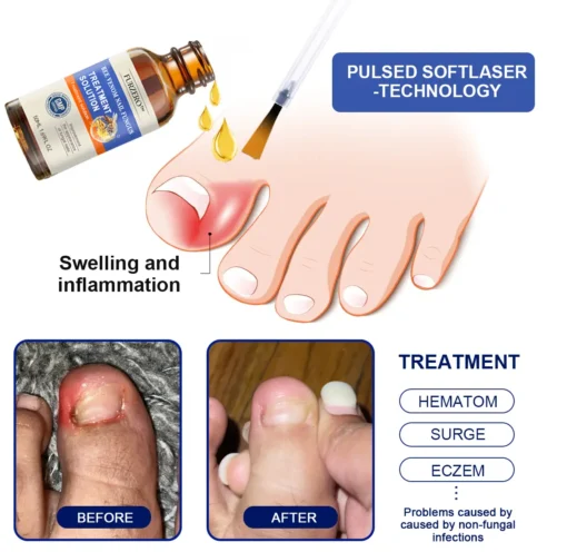 Furzero™ Bee Venom Nail Fungus Treatment Solution - Image 2