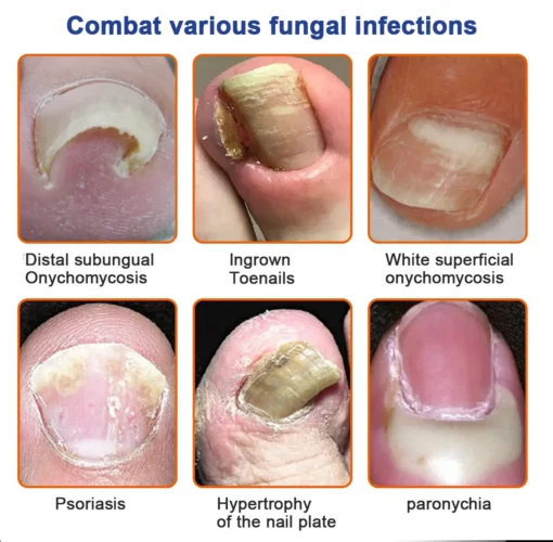 Furzero™ Bee Venom Nail Fungus Treatment Solution - Image 4